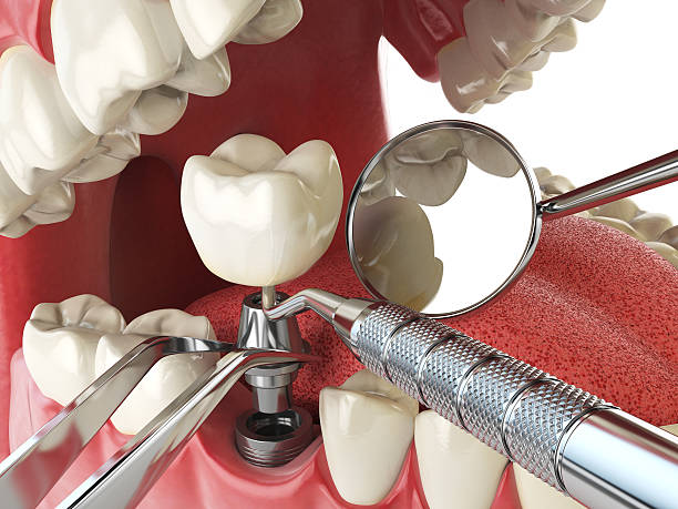 Best Emergency Dental Extractions in South Hill, NY